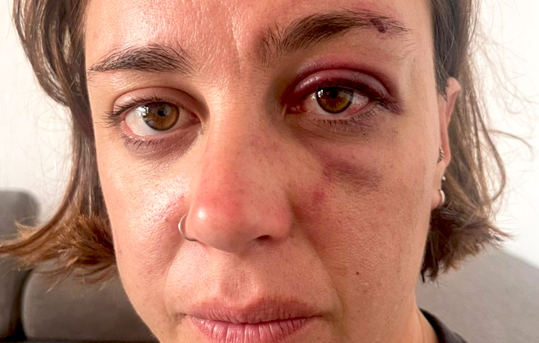 Victime d’une agression lesbophobe à Montpellier, elle dénonce également l’inaction de la police